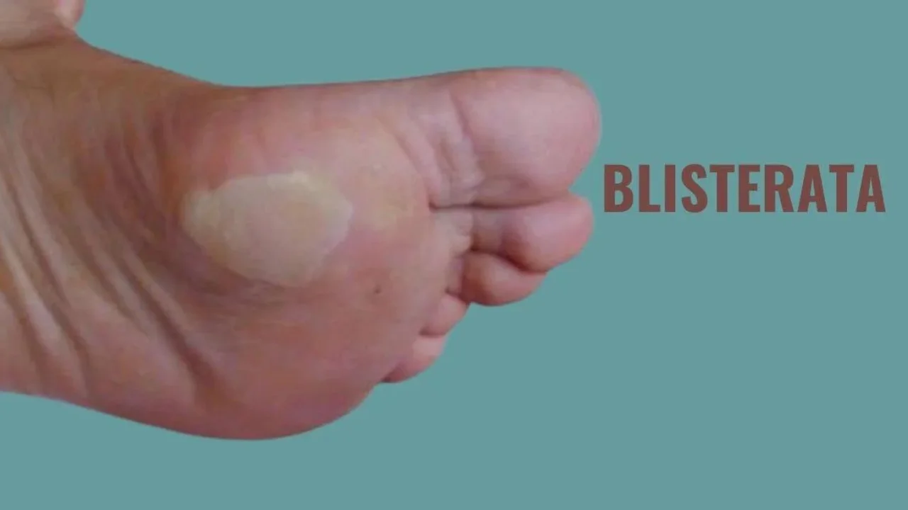 Blisterata: A Comprehensive Overview